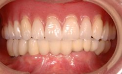 インプラント治療の流れ（下顎）～総入れ歯以外の選択肢～