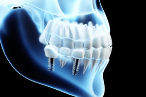 タカシ歯科のインプラントの成功率が高い理由