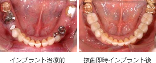 奥歯の抜歯即時インプラントの症例