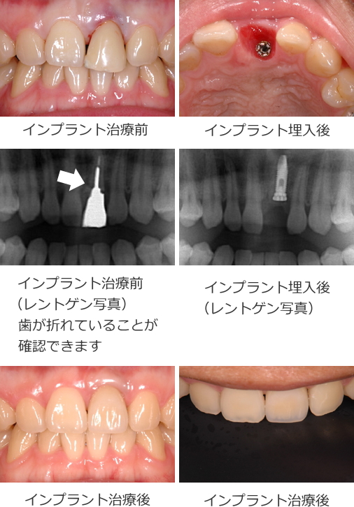 抜歯即時インプラントの症例 抜歯即時インプラントの症例