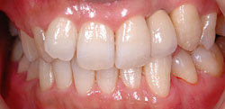 抜歯即時インプラント治療の流れ(前歯)