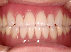 インプラント義歯(入れ歯)の治療の流れ