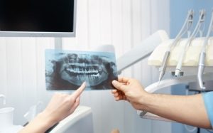 抜歯即時インプラントの症例