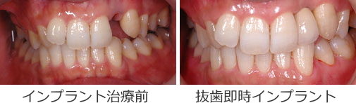 前歯の抜歯即時インプラント