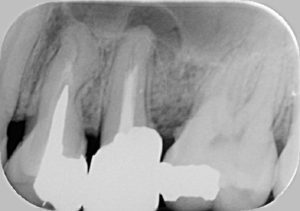 歯の根っこの治療a