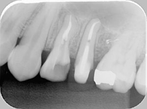 歯の根っこの治療b